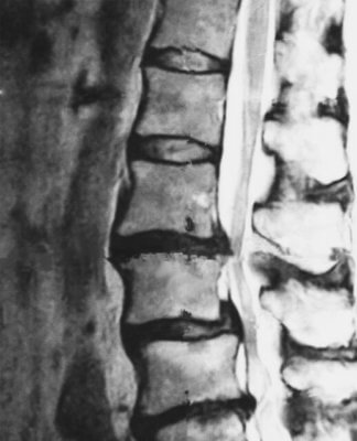 脊柱管狭窄症　MRI