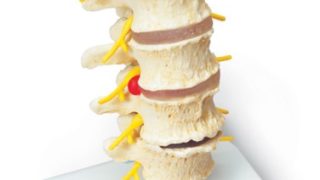 脊椎退行変性模型