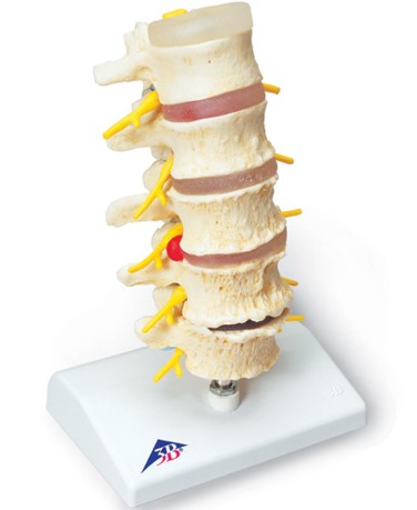 脊椎退行変性模型
